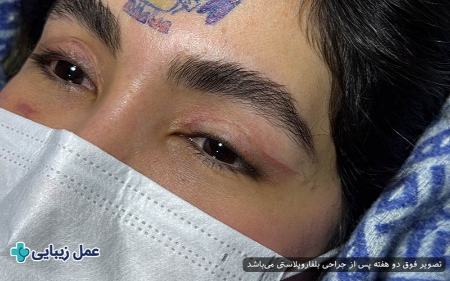بهترین عملهای زیبایی با دوره نقاهت کوتاه برای انجام قبل از عید