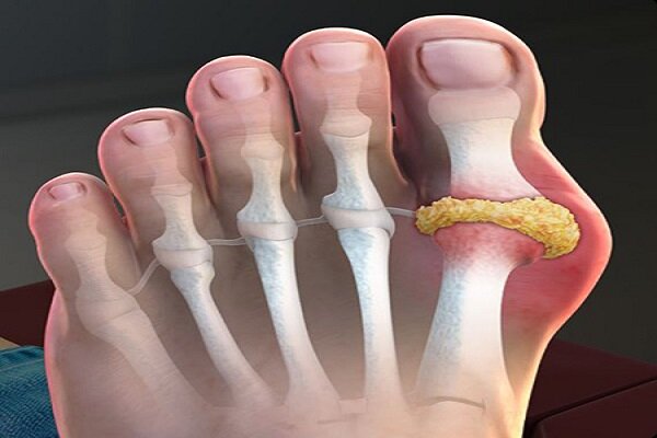 داروهای نقرس به سلامت قلب نیز کمک میکنند