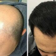 هزینه کاشت مو در تهران + قیمت انواع روش های کاشت مو در بهترین کلینیک تهران