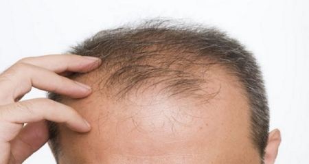 مقایسه هزینه و قیمت کاشت مو به روش SUT با FUE مقایسه هزینه و قیمت کاشت مو به روش SUT با FUE