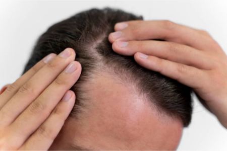 مقایسه هزینه و قیمت کاشت مو در ایران با دیگر کشورها مقایسه هزینه و قیمت کاشت مو در ایران با دیگر کشورها