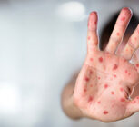 موج سرخک در بنگلادش جان ۵۰۰ کودک را گرفت